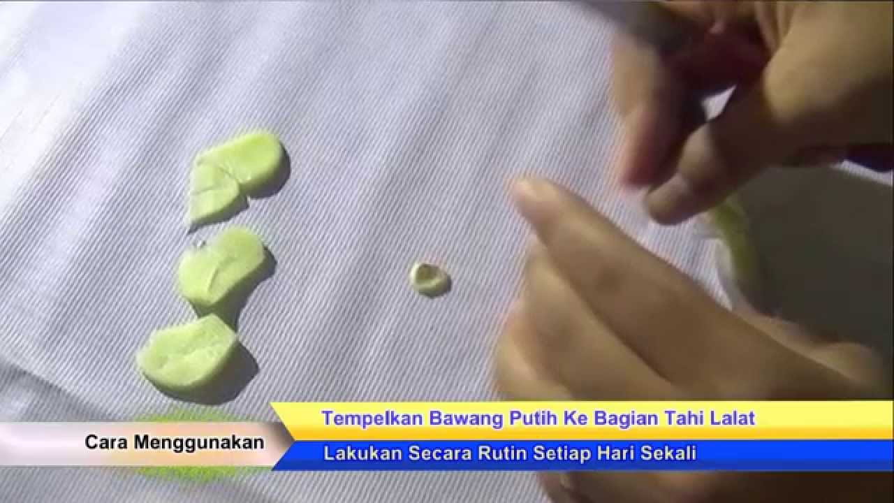  Cara  Cepat  Alami Hilangkan Tahi Lalat Dengan Bawang Putih  