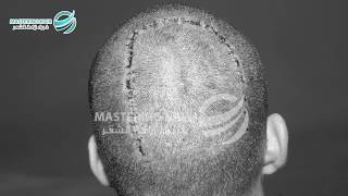 زراعة الشعر في مكان الجرح مثل جلد الرأس، اللحية، الشارب و الحواجب، يمكن اختفائه مشفى ماسترينغ هير