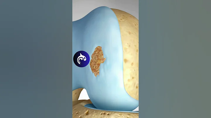 See how Damaged Knee Cartilage is restored in 3D Animation. Osteochondral Autograft (OAT)