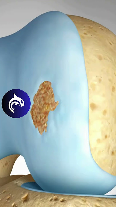 See how Damaged Knee Cartilage is restored in 3D Animation. Osteochondral Autograft (OAT)