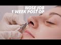 Rhinoplasty Vlog Part 2 - Splint Removal and Nose Job Recovery (1 WEEK POST OP)