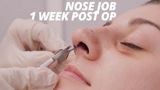 Rhinoplasty Vlog Part 2 - Splint Removal and Nose Job Recovery (1 WEEK POST OP)