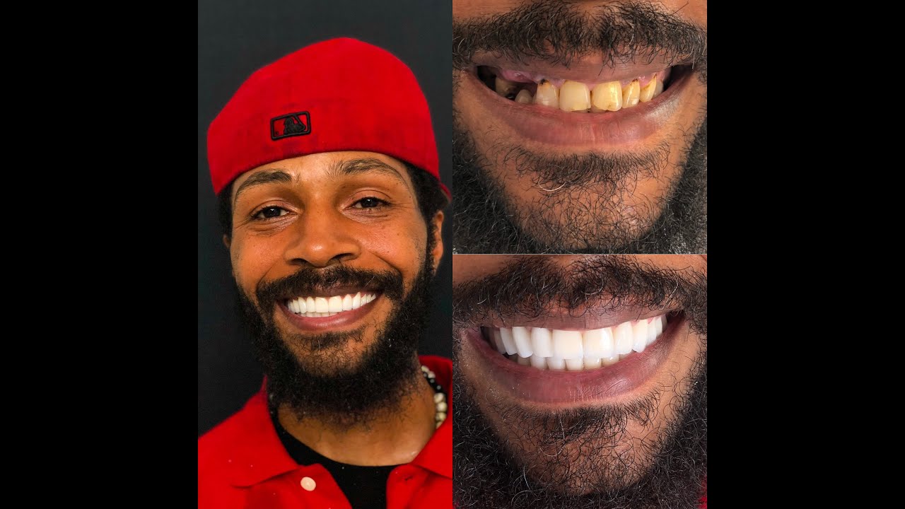 Monarch Smile Turkey — patient video