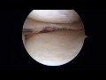 How a Meniscus Tear Is Repaired