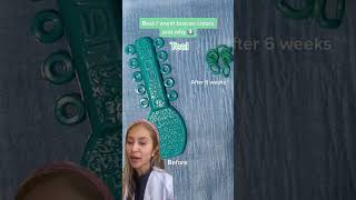 Best Braces Colors-Teal Before and After Braces Colors Teal Before And After