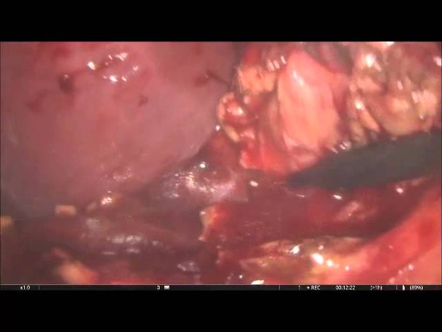 Лапароскопия при остром гангренозном калькулёзном холецистите