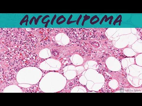 Angiolipoma: 5-Minute Pathology Pearls