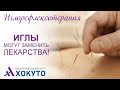 Иглорефлексотерапия, интервью рефлексотерапевта. Иглы могут заменить лекарства!