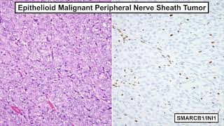 Surgical #Pathology Update: Diagnostic Pearls for the Practicing #Pathologist - Volume V screenshot 5