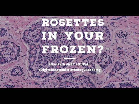 Got Rosettes in your Ovarian Tumor Frozen Section?