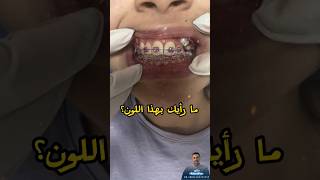 تقويم الاسنان|| الوان استك التقويم#orthodontics #orthodo #shorts #shortvideo #dr_abdullah_sultan_