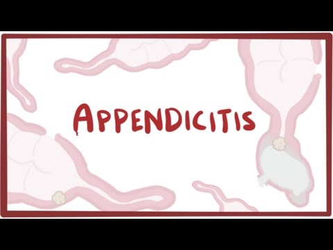 Video: Appendicitis - Symptoms, Causes, Treatment, Removal