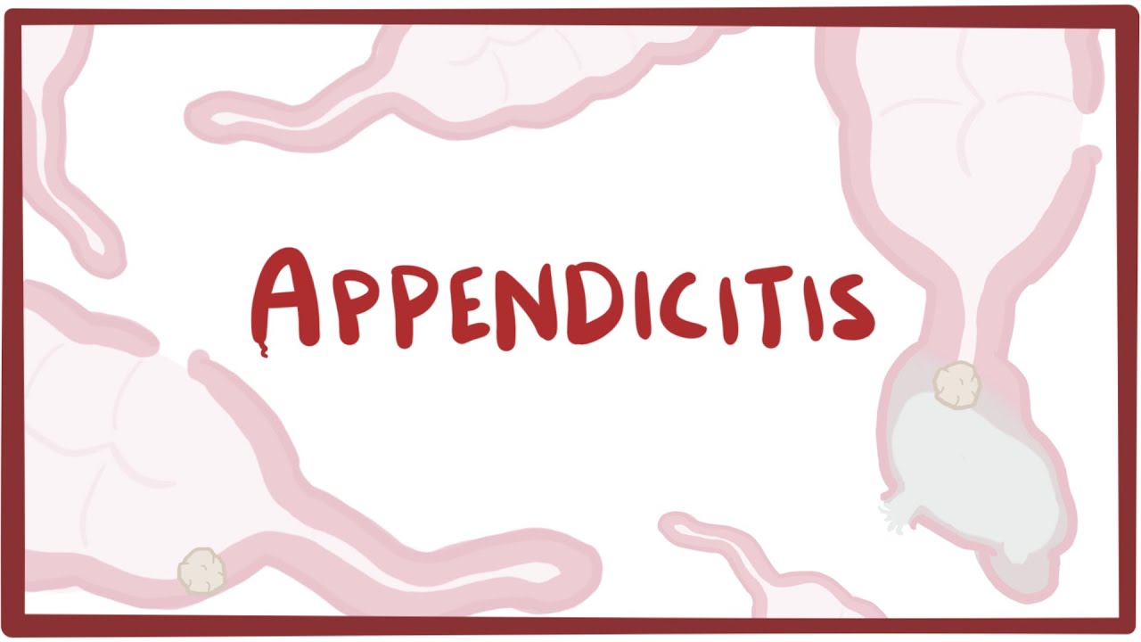 Appendicitis - Causes, Symptoms, Diagnosis, Treatment  Pathology