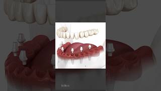 ASMR: 6 Ceramic Implants, Dental Prosthesis