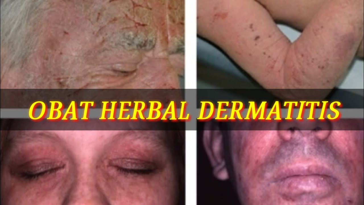 CARA MENGOBATI DERMATITIS DENGAN OBAT HERBAL