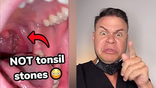 These May Look Like Tonsil Stones But They Are WAY Worse!