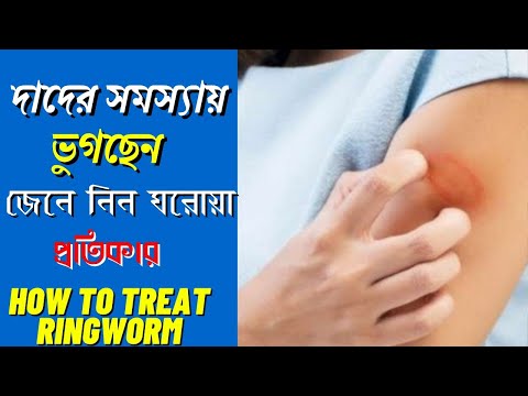 How to treat ringworm-best treatment - ringworm treatment in bengali - দাদের সমস্যার ঘরোয়া প্রতিকার