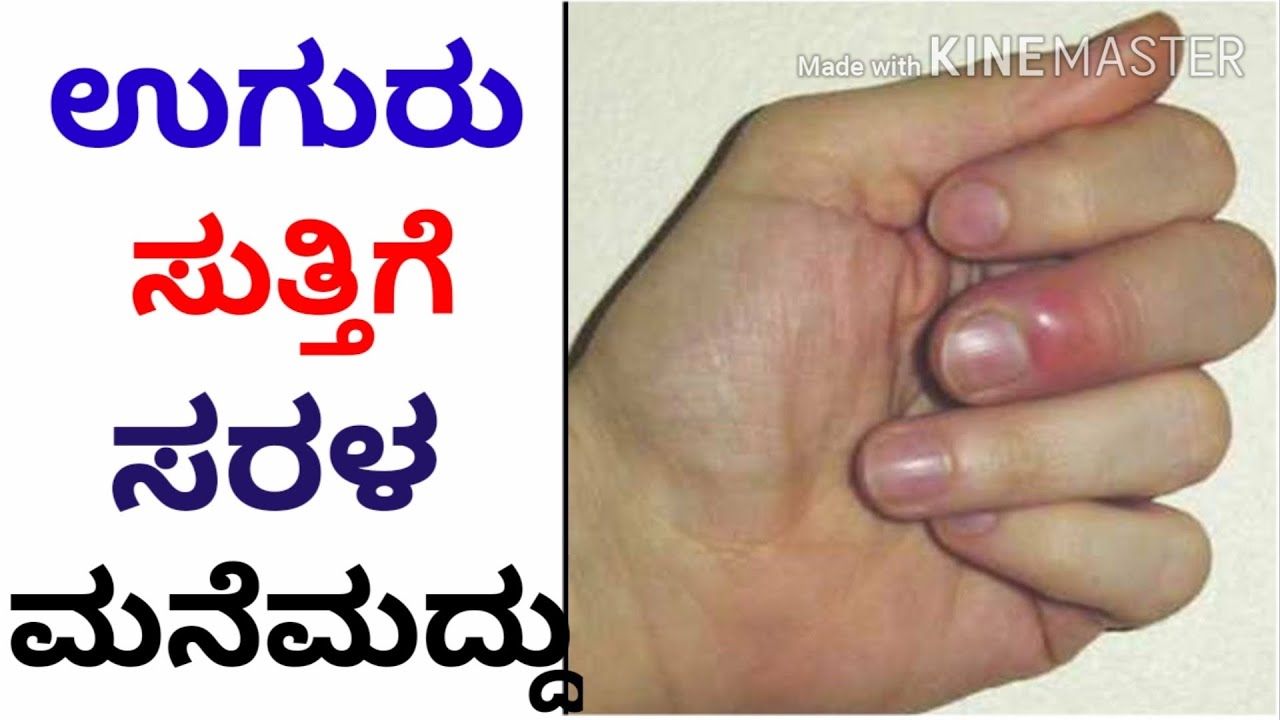 ಉಗುರು ಸುತ್ತಿಗೆ ಇಲ್ಲಿದೆ ಸರಳ ಮನೆಮದ್ದು//home remedies for nail fungus infections in Kannada./ YouTube