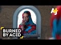 Pakistani Muslim woman has acid thrown in her face by the man whose marriage proposal she rejected