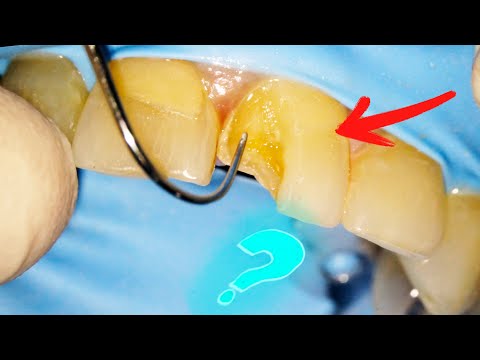 Video: Siapa yang mempunyai gigi kacip berbentuk penyodok?