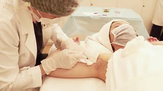 Download Lagu Quy trình cấy ức chế tuyến mồ hôi - Điều trị hôi nách MP3