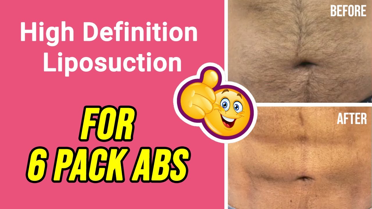  Get Abs Without Working Out With High Definition Liposuction At Handa 