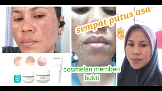 review cosmelan pack|selamat tinggal melasma|selamat tinggal flek hitam