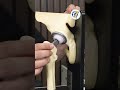 Total Hip Replacement Explained | Procedure & Surgery Time