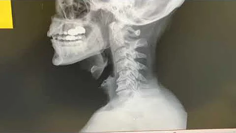 Thyroid Dysfunction and Cervical Arthritis and Degenerative Disc Disease