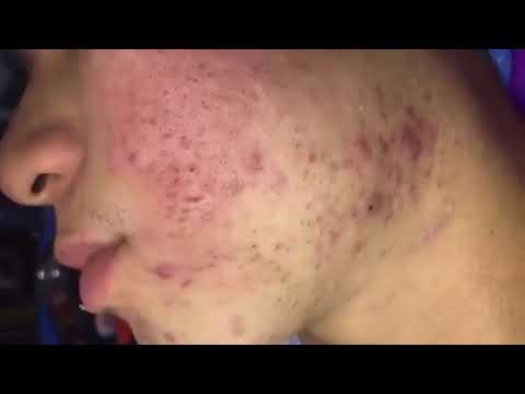 (AMAZING) !!! BEST BLACKHEAD REMOVE AND CYSTIC  REMOVE ON FACE (PART )