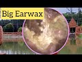 Biggest Earwax Full Of The Ear