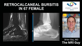 Heel pain from retrocalcaneal bursitis