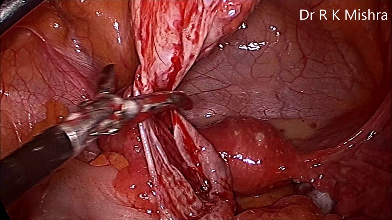 Ooforoplastia por video (cisto dermoide) / Video oophoroplasty (dermoid  cyst) 
