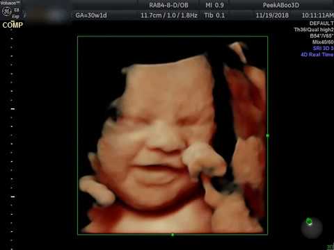 Peekaboo3d 4d 5d 6d Ultrasound Virginia United States