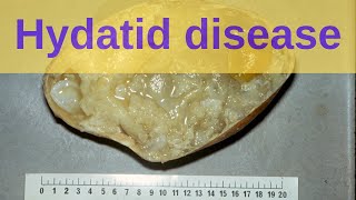 What is Hydatid Disease?  Pathology mini tutorial