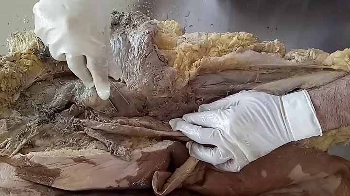 DISSECTION OF GLUTEAL REGION AND BACK OF THIGH BY DR MITESH DAVE