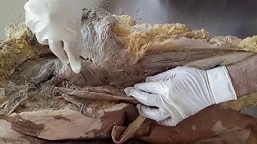 DISSECTION OF GLUTEAL REGION AND BACK OF THIGH BY DR MITESH DAVE