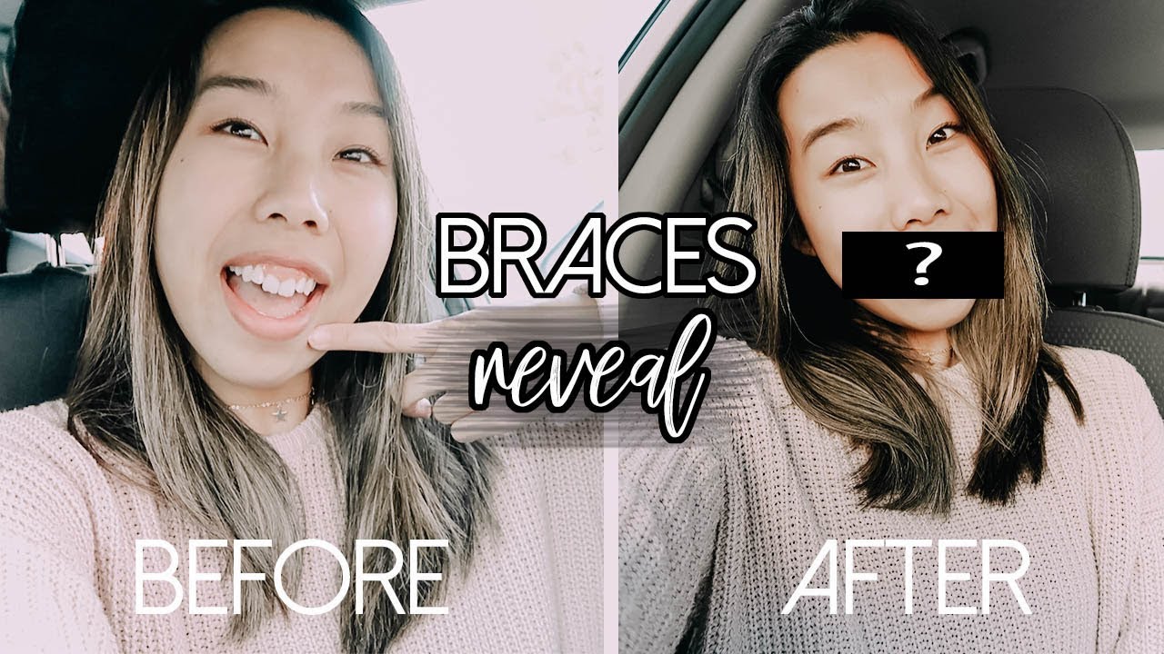 BRACES REVEAL! I FINALLY DID IT! (Braces Journey Part 1) Emily Dao