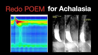 Redo POEM for Achalasia