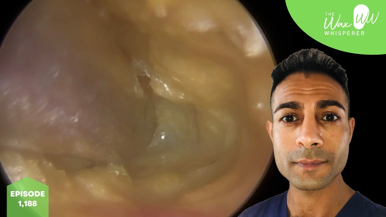 1,188 Complex ‘Operation Game’ Ear Wax Removal YouTube