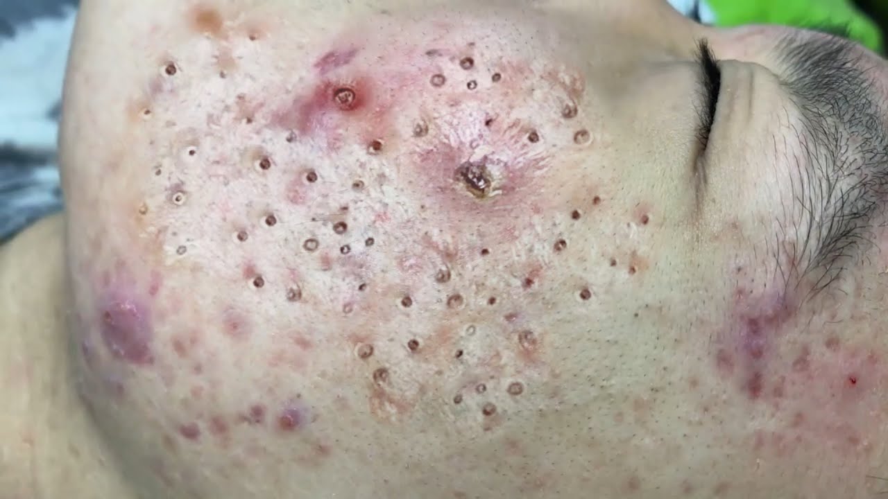 TREATMENT OF BIG BLACKHEADS AND HIDDEN ACNE IN THE FACE