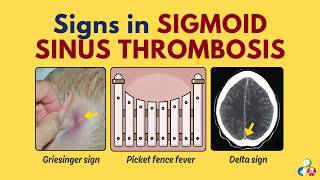 Signs in Sigmoid Sinus Thrombosis | Delta Sign, Griesinger Sign and Picket Fence Fever