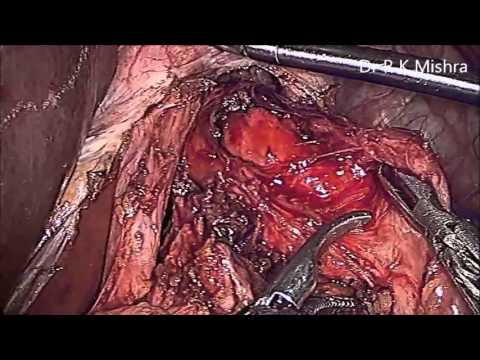 Laparoscopic Cardiomyotomy And Dor Fundoplication