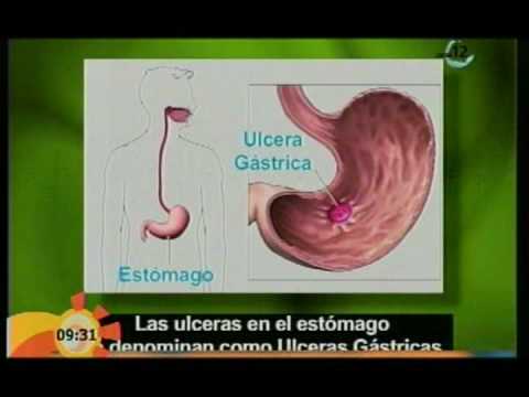 Vídeo: Duodeno: Inflamación, úlcera, Cáncer