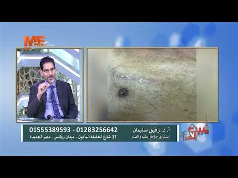 أ د رفيق سليمان مراحل مرت بها جراحات القلب حتى وصلت للتدخل المحدود