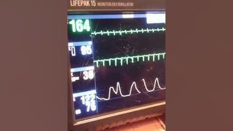 Adenosine SVT Conversion