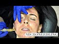 NIKKI GETS A NEW FACE Microneedling for acne scars!  BEFORE AND 6 MONTHS AFTER!