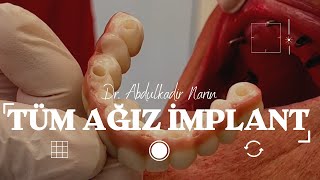 Tüm Ağız İmplant Nedir? Tam Dişsizlikte İmplant