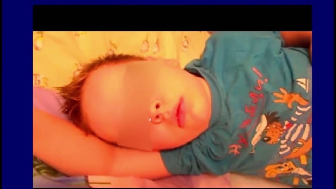 Ночное апноэ у детей как последствие гипертрофии миндалин и аденоидов✧Лечение