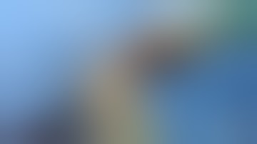 Amplatzer plug 4 occlusion of large renal AVF